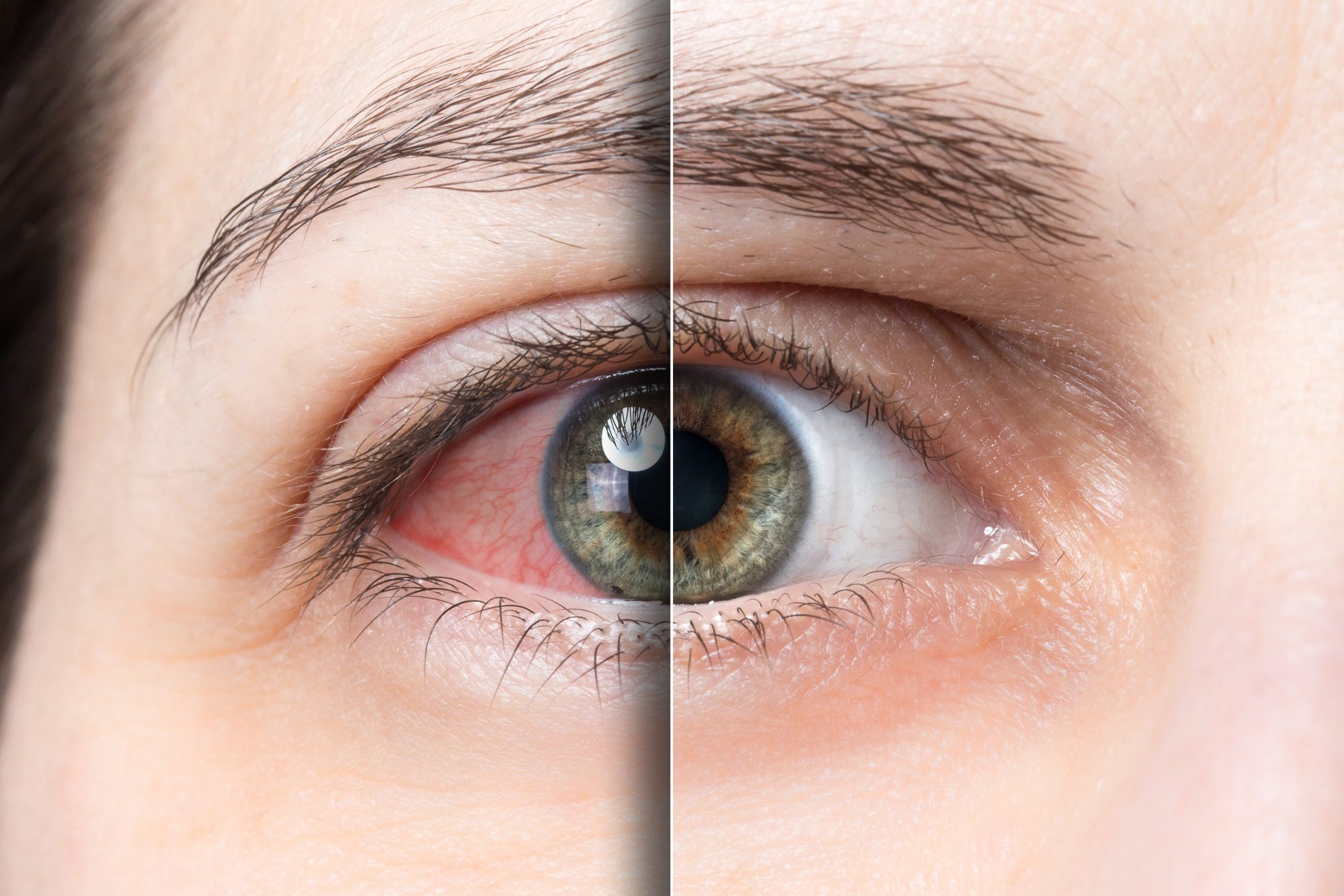 Red,Eye,Before,And,After,Treatment